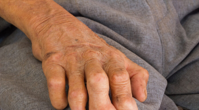 leprosy hand
